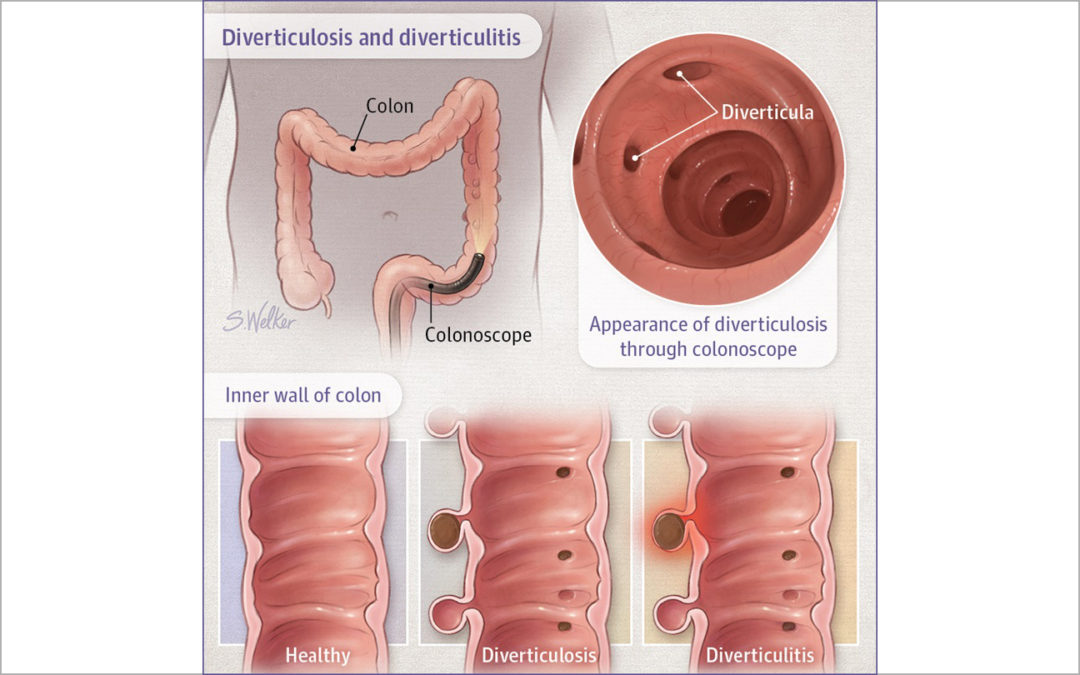DIVERTICULOSIS and DIVERTICULITIS | Evergreen Family Health